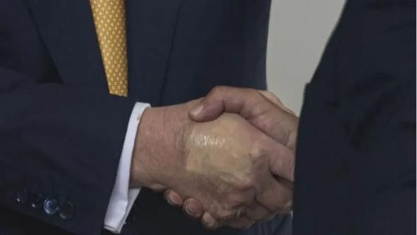 Trump'a şok teşhis! Vücudundaki şişlik ve morlukların sebebi açıklandı...