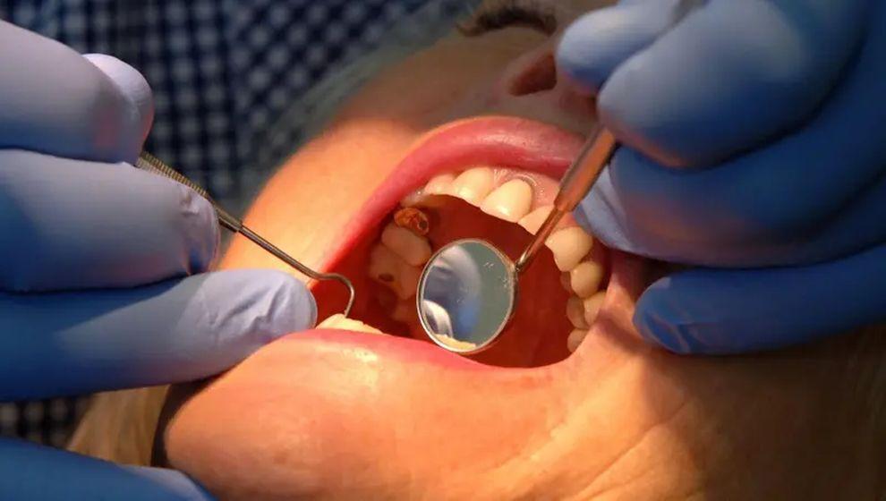 Diş minesini onaran yeni jel çürüklerle mücadelede çığır açabilir