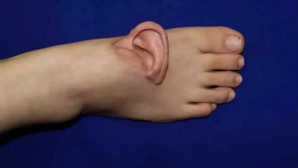 Çin'de tıp tarihinde bir ilk: Kopan kulak geçici olarak ayağa dikildi