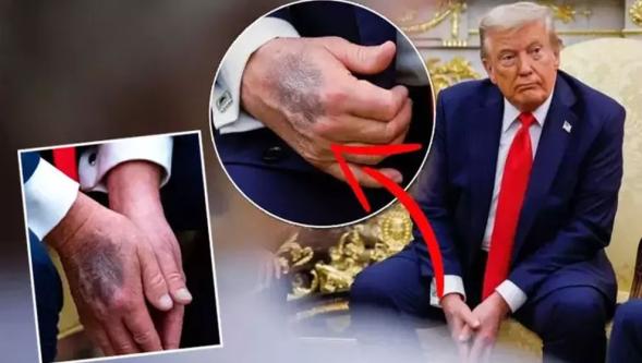 Trump elindeki morlukların sebebini açıkladı